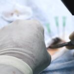 Hair Transplant