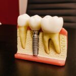 implantes dentales precio