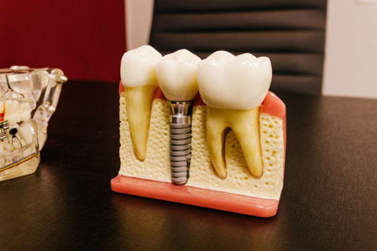 implantes dentales precio